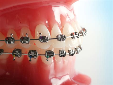 g&h orthodontics brackets